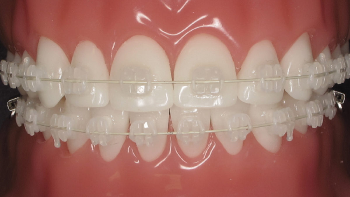 Ceramic braces smile correction result