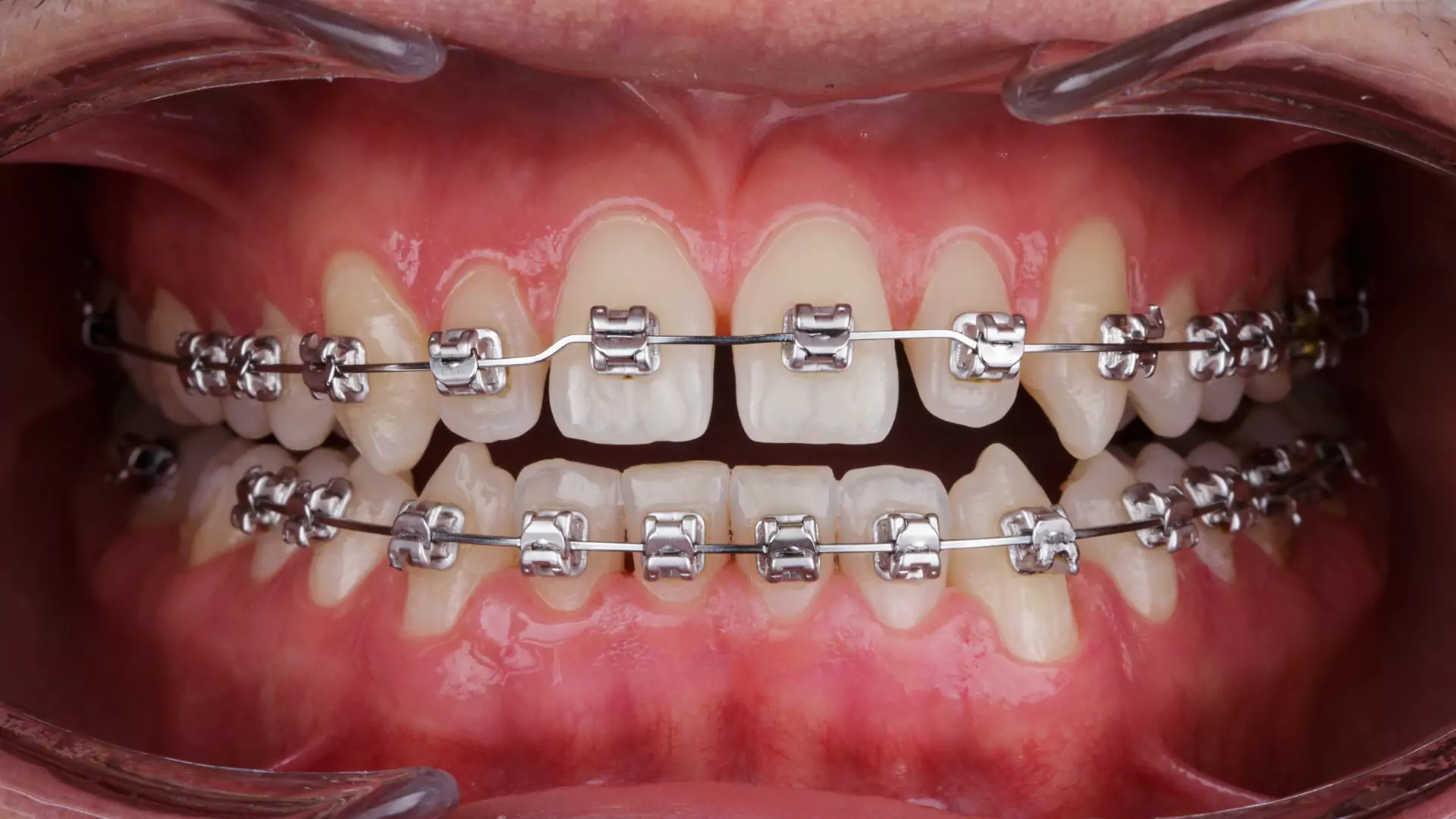 Metal braces treatment consultation